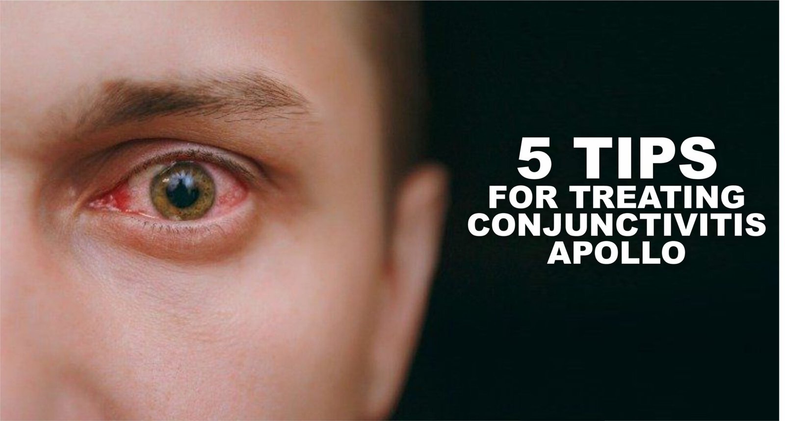 5 Tips For Treating Conjunctivitis Apollo